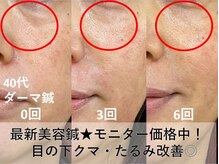 目のクマ・たるみ★最新美容鍼【ダーマ鍼】モニター特別価格