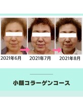 ビューティービューティー 中央通り店(beauty beauty)/コラーゲンリフトアップ結果