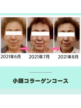 ビューティービューティー 中央通り店(beauty beauty)/コラーゲンリフトアップ結果