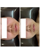 ハル(Halu)/赤み改善♪