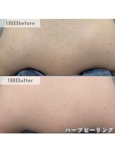 ネイルズビー 別邸(Nail's be)/背中のニキビケアに◎