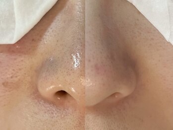 チル(Chill)の写真/【毛穴の黒ずみ/ザラつき/皮脂詰まり】繰り返さない毛穴洗浄コース☆