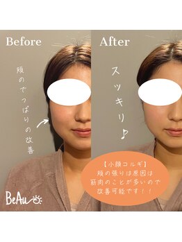 ボー(BeAu)/【頬の張り改善】