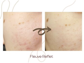 フルーヴ ルフレ(Fleuve Reflet)/ニキビケアと一緒に毛穴ケアも♪