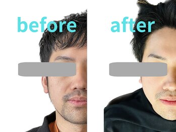 ゼン整体(ZEN)/小顔矯正2回目と13回目の比較