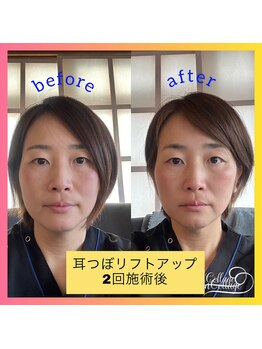 ネオ(Neo)/耳つぼ”リフトアップ”施術