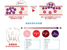 火水風接骨院/カッピング（吸い玉療法）