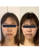 ハイコガオ 中崎町店(HIKOGAO)/小顔矯正