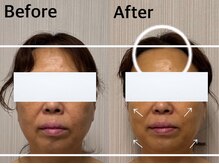 ベール(BEHL)/コルギのBefore After