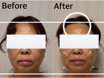 ベール(BEHL)/コルギのBefore After