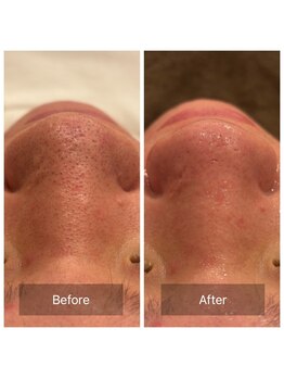 リジュベ(Rejuve)/毛穴/毛穴洗浄/船橋エステ/男性