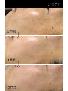 ミニン(minin)/シミケア