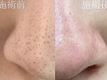 ジェリー(JERRY)の写真/【いちご鼻撃退】春のケアが夏の毛穴を変える◎まずは、角栓・黒ずみを徹底的にリセット！
