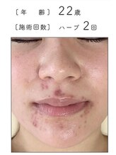 リベル 名古屋(Lebelle:)/ハーブピーリング専門名古屋