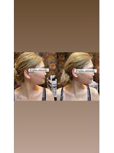 ビプラス(VIPLAS)/小顔メニュー