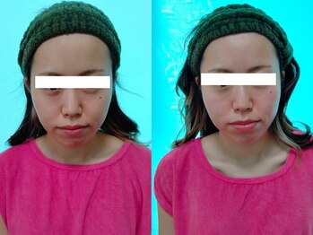 ソフィーム/エンビロンフェイシャル一回