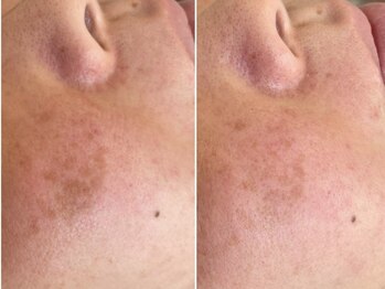 エレヌイ(ELENUI)/最新光フェイシャル★シミ改善