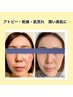 花粉の乾燥敏感肌ケア★生コラ艶肌コース￥5.980