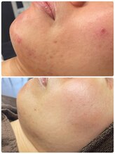 ニコリ(Nicori)/ハーブピーリング