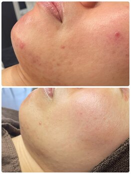 ニコリ(Nicori)/ハーブピーリング