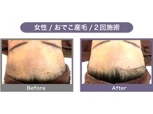 アンフィー 川西能勢口店(Une f`ee)/顔脱毛のBefore,After★