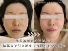 ビカオ(BIKAO)/ハーブピーリング