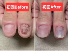 マニブルーム/陥没したお爪Before&After親指