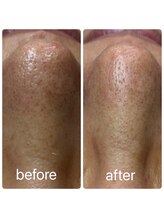 スキンラボ カホクカイ(KaHokuKai)/初回　　