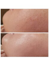 サロン ソワイユ(salon soyeux)/気になる毛穴、小じわもつるん♪