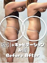 レチカ(Rechica)/吸い上げ（吸引）＋キャビ