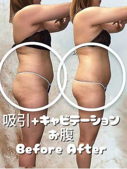 レチカ(Rechica)/吸い上げ（吸引）＋キャビ