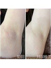 リフレッシュサロン/脱毛before⇒after