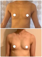 美人バスト 本厚木店/【バストアップ☆育乳】 症例☆