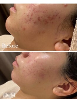 ルーヴェ(Luve)/陶肌トリートメント