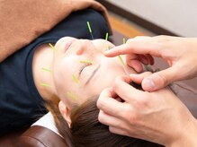 もみの木鍼灸接骨院/【美容鍼】お肌もスッキリ