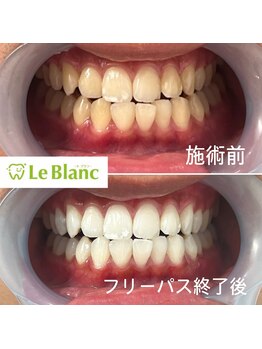 ルブラン 奈良店(Le Blanc)/真っ白で綺麗な歯(^^)
