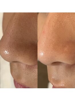 ミニョンプラス(Mignon+)/肌力あげるフェイシャルワックス