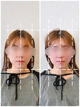 イズム まつもと店(izm)/小顔矯正　モニター様