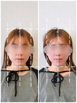 イズム まつもと店(izm)/小顔矯正 モニター様