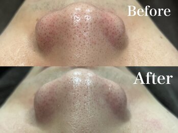 ウード(oud.)/イチゴ鼻をなんとかしたい☆