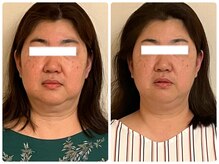 ベルソー(Berceau)/小顔矯正