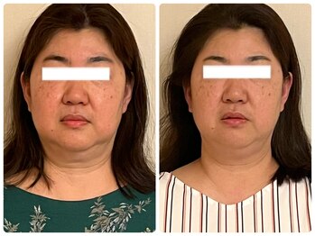 ベルソー(Berceau)/小顔矯正