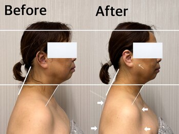 ベール(BEHL)/コルギのBefore After