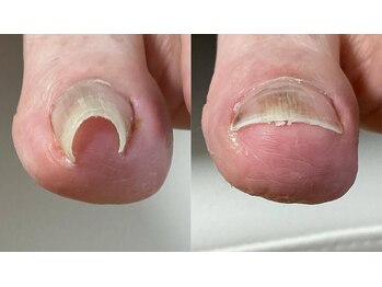 【巻き爪/深爪/フットケア】巻き爪本舗　津田沼店/問題ありません！