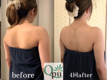 キュープ 福岡天神店(Qpu)の写真/ブライダルに大人気＊肩首の凝りをほぐしてラインを美しく肩甲骨の可動域を広げ背中別人級を実現◎