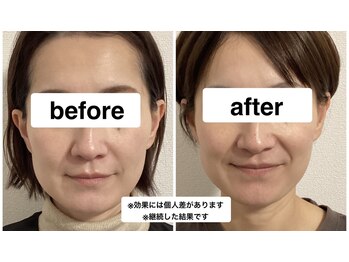 グリーン鍼灸整体院(green鍼灸整体院)/美容鍼