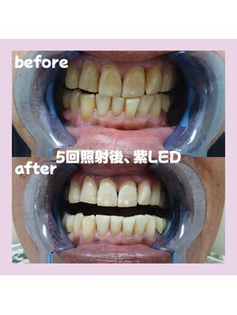 パレ 大阪十三店(Palet)/喫煙者のbefore/after