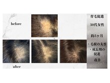 美箱 赤坂店/☆育毛促進☆幹細胞x美容原液