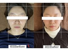 ダイアリー(DIARY)/小顔矯正