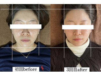 ダイアリー(DIARY)/小顔矯正